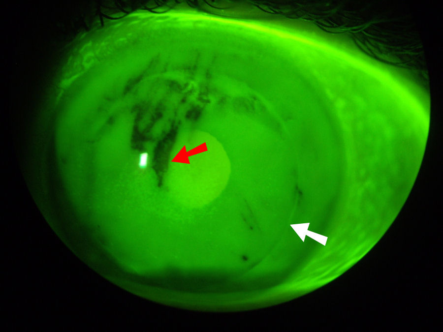 Lasik dry eye treatment