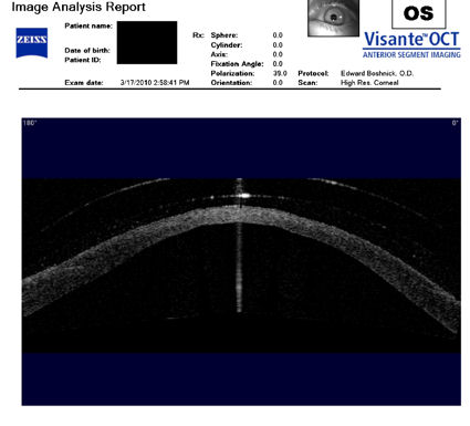 post LASIK ectasia