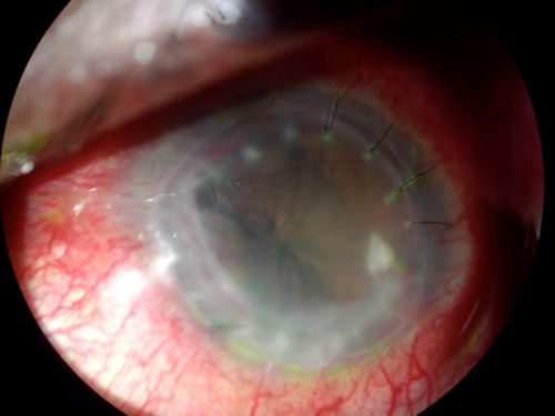 corneal transplant disaster