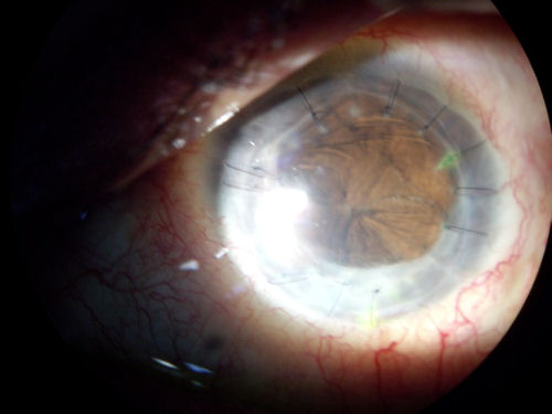 post transplant infection vitrectomy Phthisis Bulbi