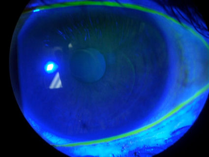 The next photo shows a cornea with two LASIK flaps.
