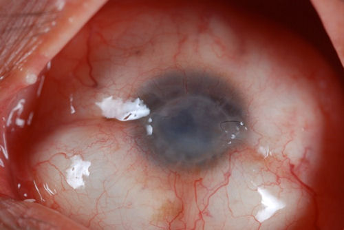 15 months after rejected corneal transplant