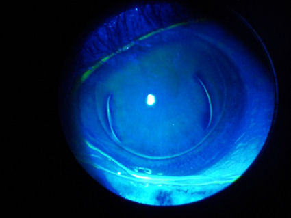 The photo below shows an irregular LASIK flap resulting from eye movement.