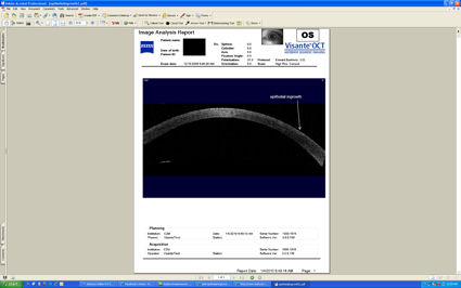click to view epithelial ingrowth after LASIK