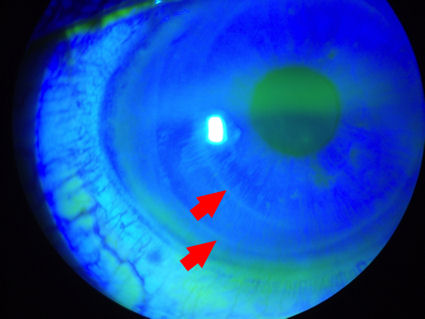 eye with two LASIK flaps