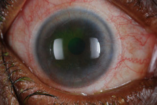 post RK post LASIK diseased cornea