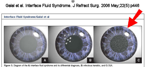 DLK, Diffuse Lamellar Keratitis