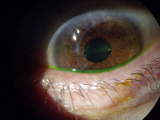 botched RK followed by off-center corneal transplant