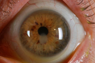 post RK post LASIK ectatic cornea with central scar