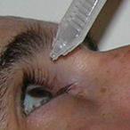 instilling artificial tears after LASIK