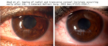 gaping RK incisions after corneal collagen crosslinking
