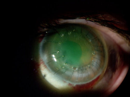 photo of corneal transplant