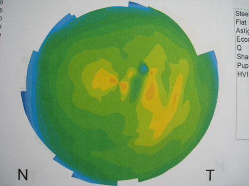topography of normal unoperated eye